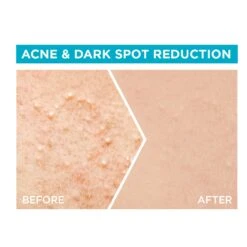 Garnier Fast Clear 4% Salicylic Acid, Vitamin C, Niacinamide, AHA - Anti-Acne Treatment Booster Serum -Personal Care Product Store 5 FC serum PDPs 2024