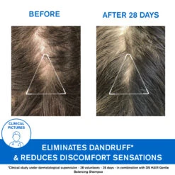 URIAGE D.S Anti-Dandruff Treatment Shampoo 200ML -Personal Care Product Store Large DS 3661434009303 BEFOREAFTER EN Variation01 Landscape 16 9